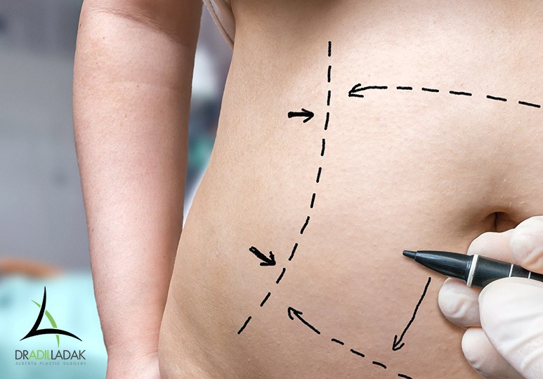 How Is a Liposuction Performed?