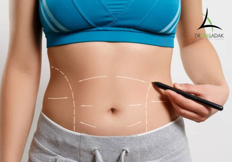 A Plastic Surgeon's Guide To Recovering After Abdominoplasty