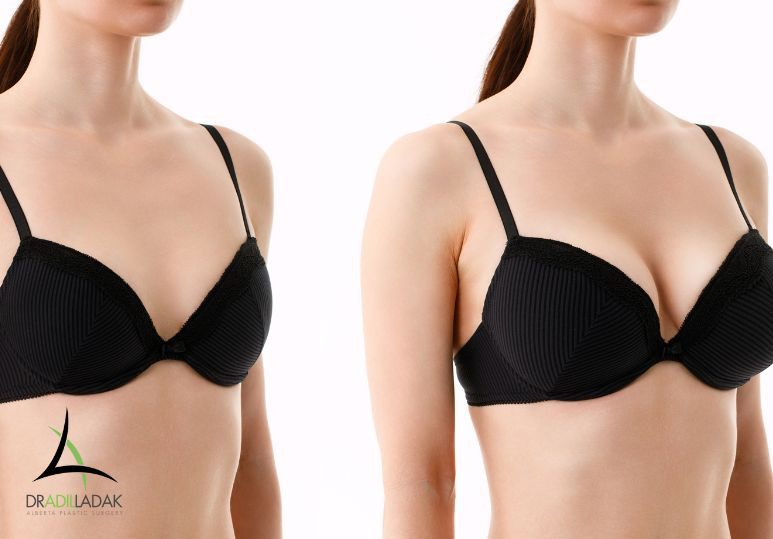 Enhance Your Look with a Push-Up Bra and Breast Implants