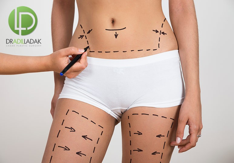 How Effective is Liposuction?