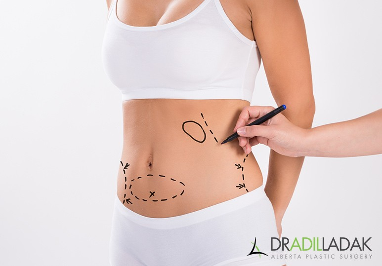 Tips For a Successful Tummy Tuck Recovery