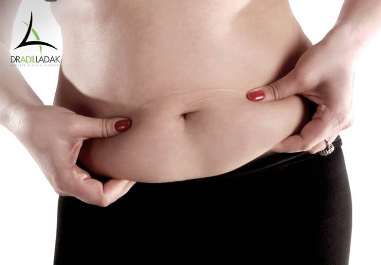 Alberta Plastic - Why Do I Still Have A Belly After My Tummy Tuck
