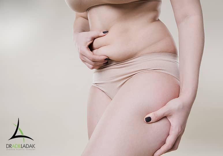 Alberta Plastic - The Benefits Of Combining Liposuction With A Tummy Tuck