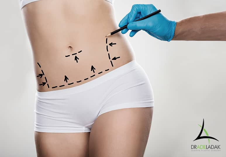 Alberta Plastic - How Your Plastic Surgeon Will Achieve The Most Natural-Looking Tummy Tuck Results