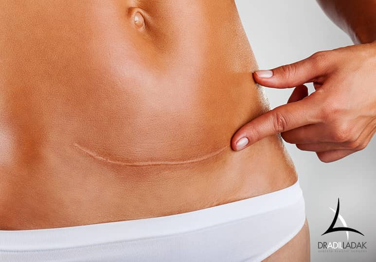 5 Tips To Minimize Tummy Tuck Scars