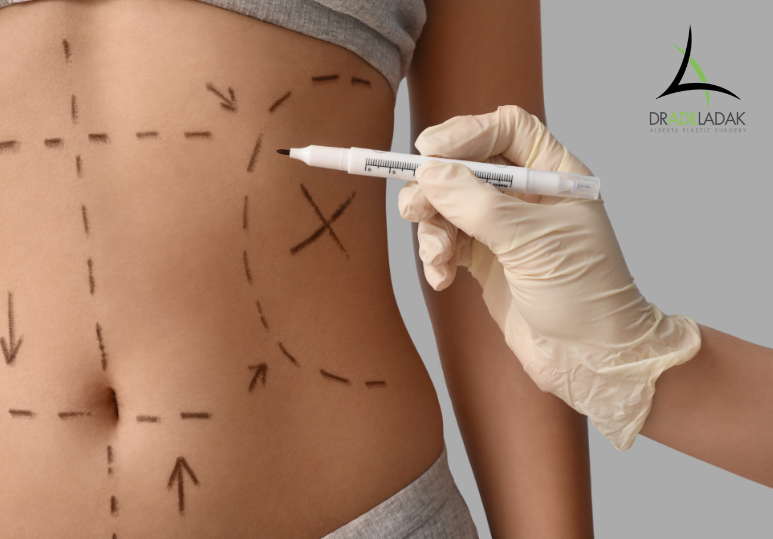 Benefits of Abdominoplasty After Weight Loss or Pregnancy 
