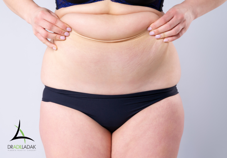 Is a Tummy Tuck Right for You? What Edmonton Patients Should Know