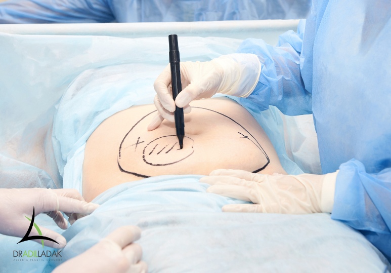 Target Stubborn Fat with Liposuction: What Edmonton Patients Should Know