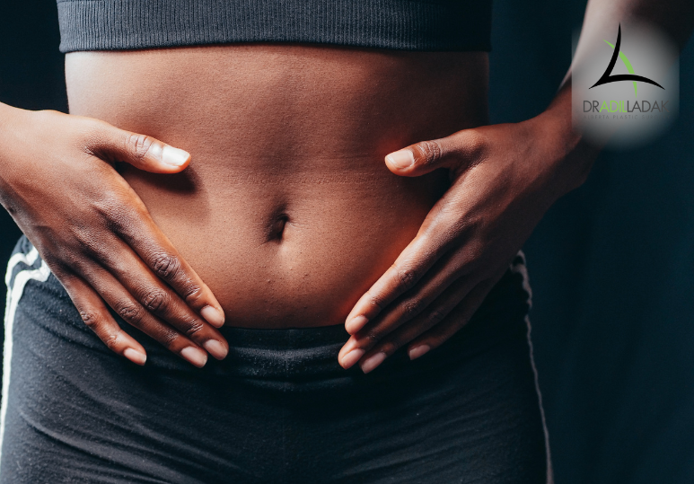 Tummy Tuck Procedure and Recovery in Edmonton: What to Expect Week by Week 