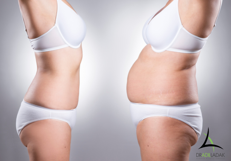 Liposuction Results in Edmonton: When Will I See a Difference?