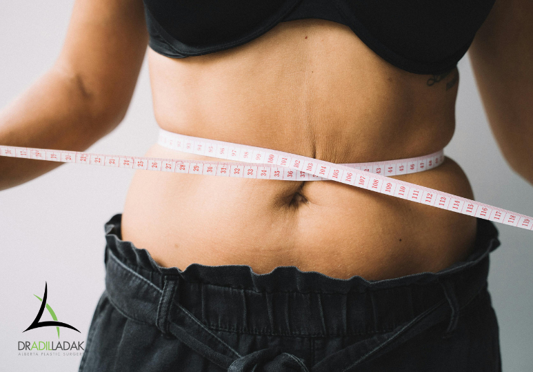 Tummy Tuck Recovery Timeline: What to Expect Week by Week 