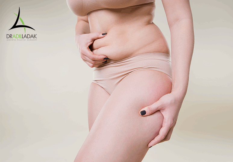 Tummy Tuck Surgery : to improve the appearance of the abdomen