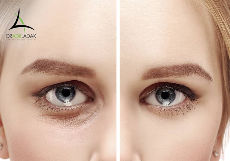 Eyelid Surgery Recovery: What To ﻿Expect