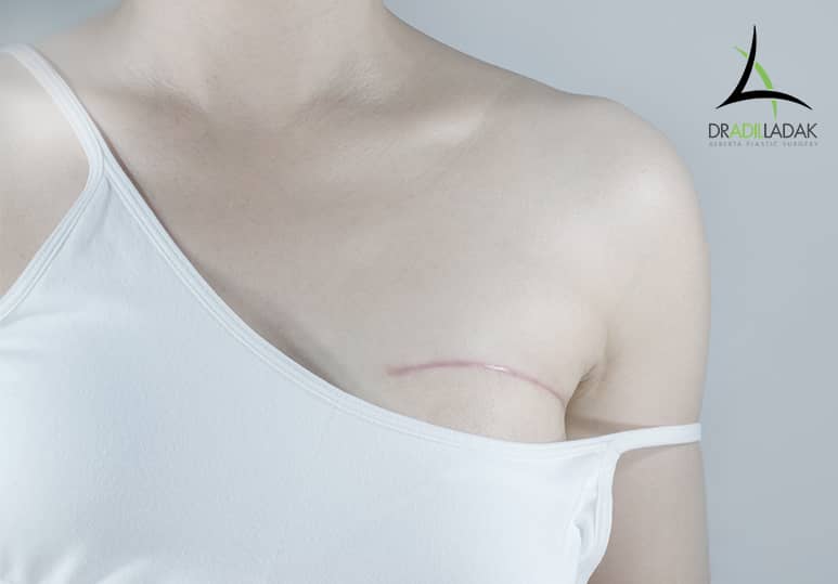 What Will My Scars Look Like After Breast Lift Surgery?