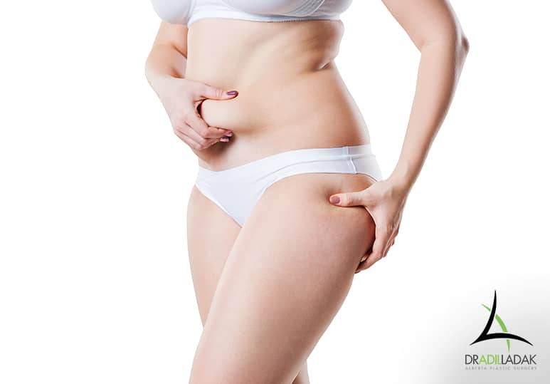 How To Prepare For Your Liposuction Procedure