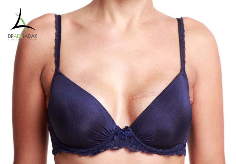 Wearing an Underwire Bra After Breast Reduction Surgery