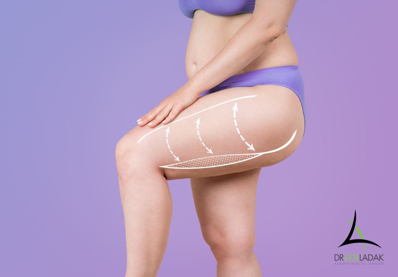 Sculpting Confidence: Medial Thigh Lifts for Toned Legs After Weight Loss