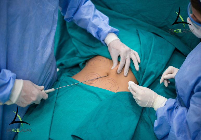 Targeting Stubborn Fat: How Liposuction Can Shape the Areas Exercise Can’t 