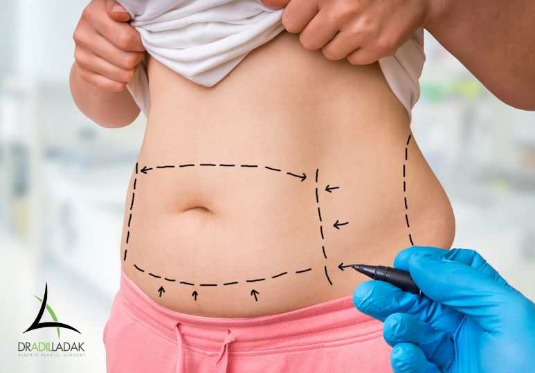 What to Know Before Getting Liposuction – Liposuction Edmonton