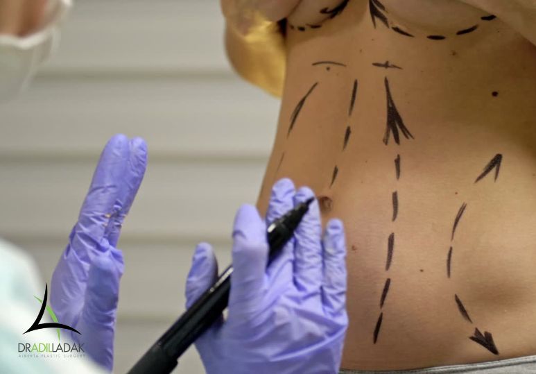 Liposuction vs Tummy Tuck: Key Differences – Liposuction Edmonton