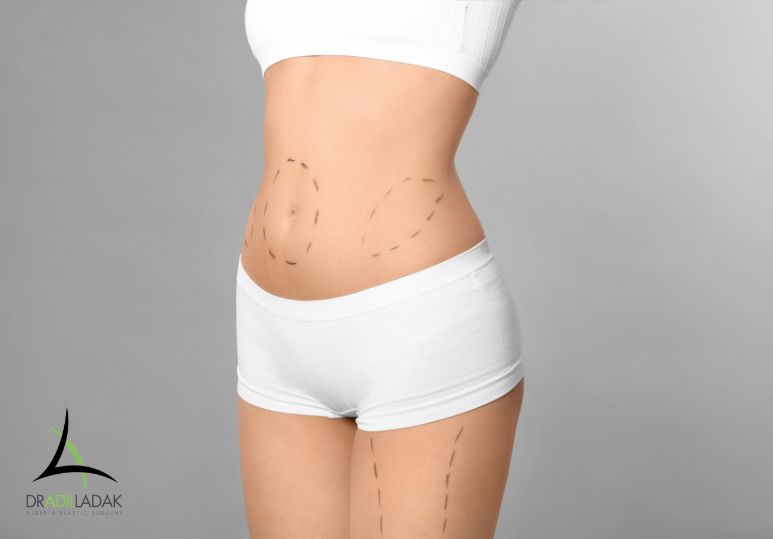 Is Liposuction Permanent? Long-Term Results Explained - Liposuction Edmonton