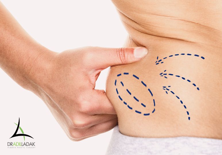 Stubborn Fat That Won’t Go Away | Liposuction Edmonton