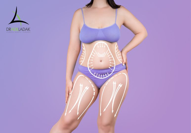 Where Liposuction Works Best - Liposuction Edmonton