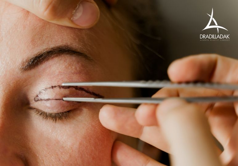 How Long Do Eyelid Surgery Results Last? - Eyelid Surgery Edmonton